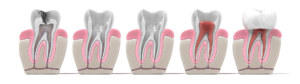 3D render of all the steps of a root canal procedure. This image helps to visualize and answer the question. "how long does a root canal take".