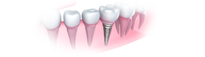 3D render showing a completed dental implants process.