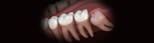 3D render of a wisdom tooth. Using this image, the team at Waterdown Smiles Dentistry answers the question "what to do after wisdom teeth removal" and gives much more info about wisdom teeth.